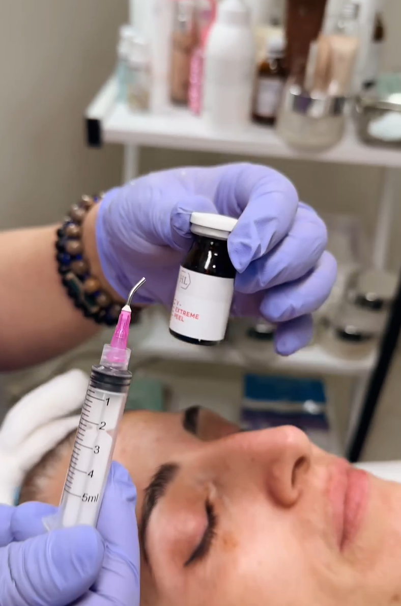 მიკრონიდლინგი / Microneedling